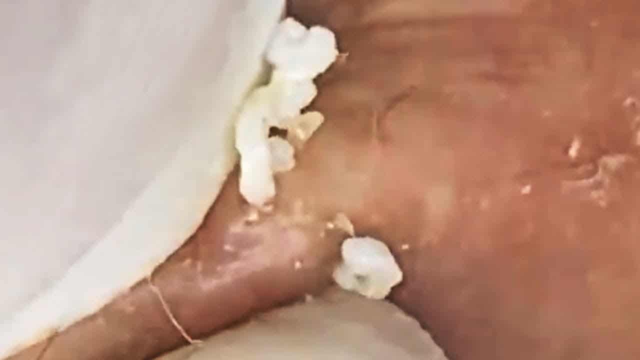 Big Cystic Acne Blackheads Extraction Blackheads & Milia, Whiteheads Removal Pimple Popping #05