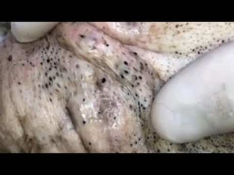 Big Cystic Acne Blackheads Extraction Blackheads & Milia, Whiteheads Removal Pimple Popping #179