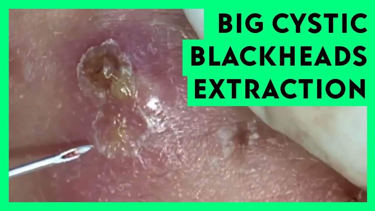 Big Cystic Blackheads Extraction