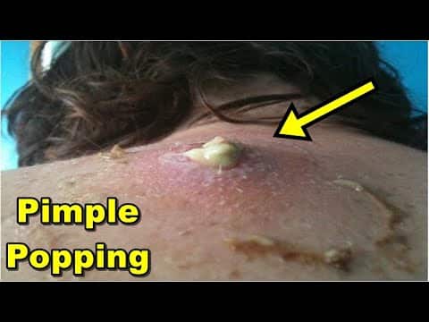 Big Cystpimple Popping Videos – Pimple Popping New Videos