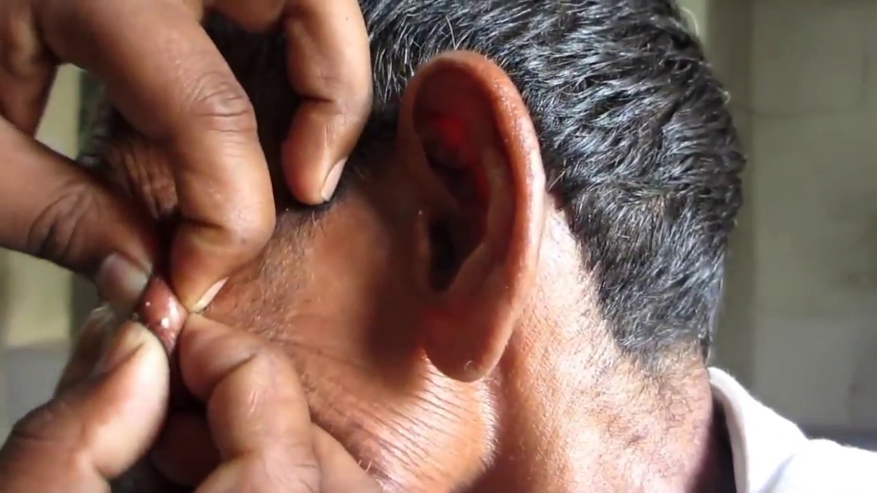 Big Drainage of Cyst Popping