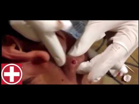 Big Inflamed Cyst Popping On Chin! HD You tube