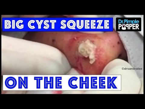 Big Inflamed Cyst Popping On Chin! by health