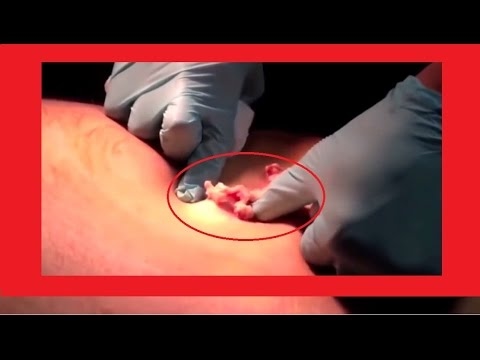 Big/large Infected cyst popping , Removal Process