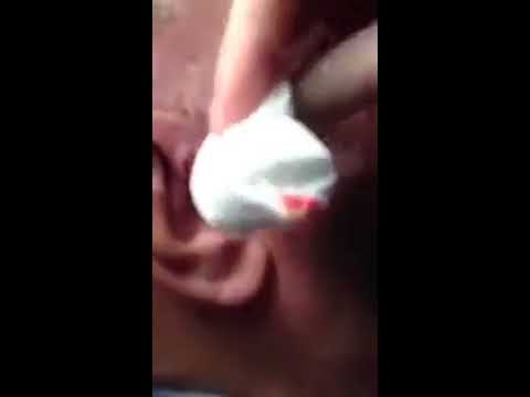 Big papa zit . pimple zit popping on the ear -All pimples of the earth-