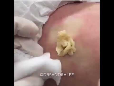 Big Pimple Popping