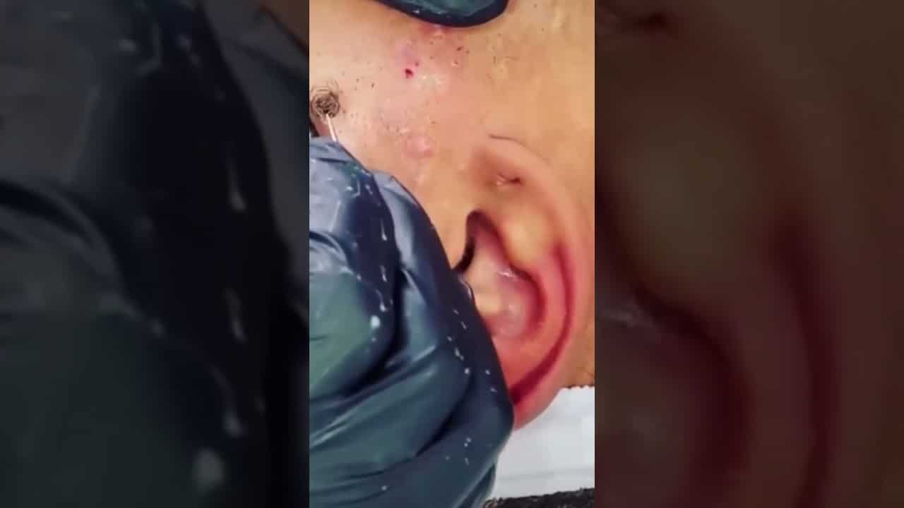 BIG Pimple Popping Huge And Blackheads Pop Compilation #9
