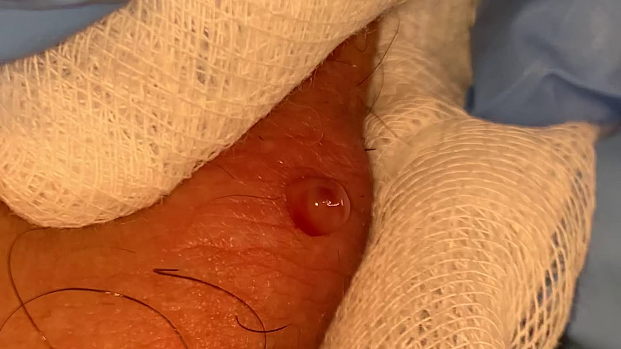 BIG PIMPLE POPPING ! VERY SATISFYING TO WATCH!