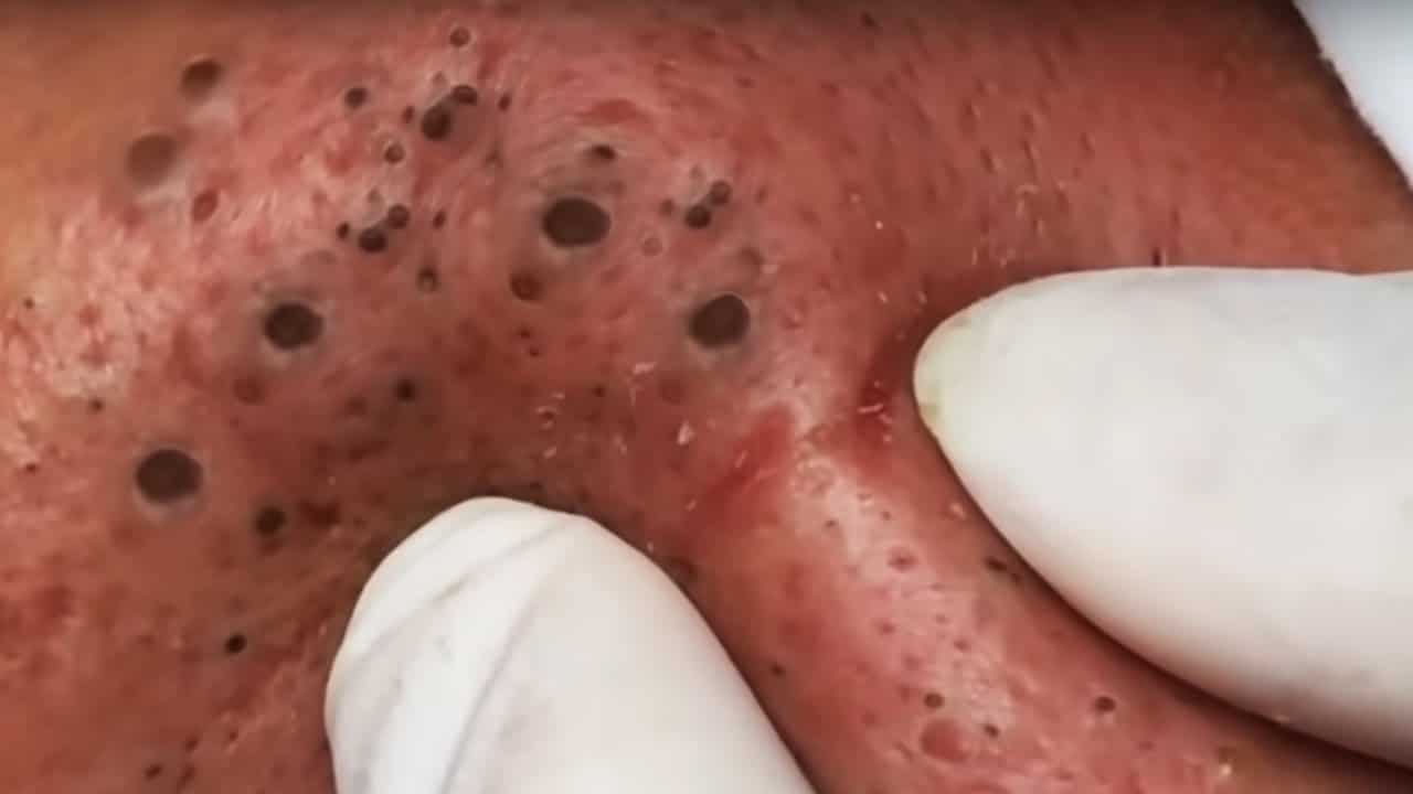 Big Pimple Pops and Large Cysts!  Dilated Pores of Winer and More!