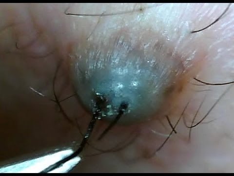 BIG PIMPLES N’ CYST COMPILATION!! GROSS…