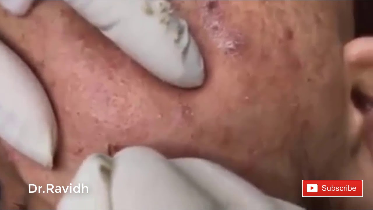 Big Stringy Sebaceous Cyst Popping And Pimples, Acne Treatment On Face Part 17