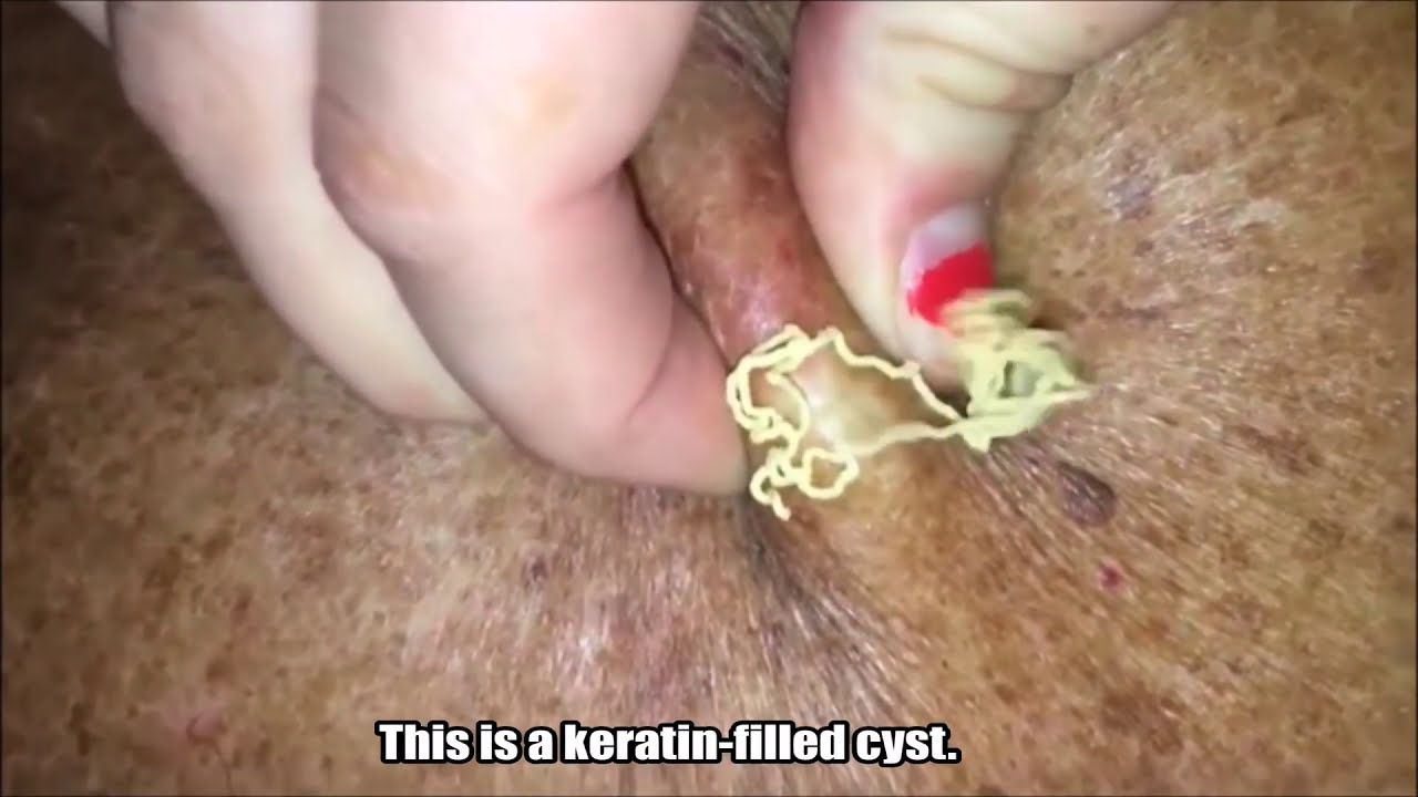Big Yellow Cyst Explodes!  Keratin Filled Cyst