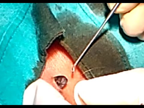 Biggest Blackhead Removal / Blackhead Popping / Comedo / Dilated Pore of Winer Extraction