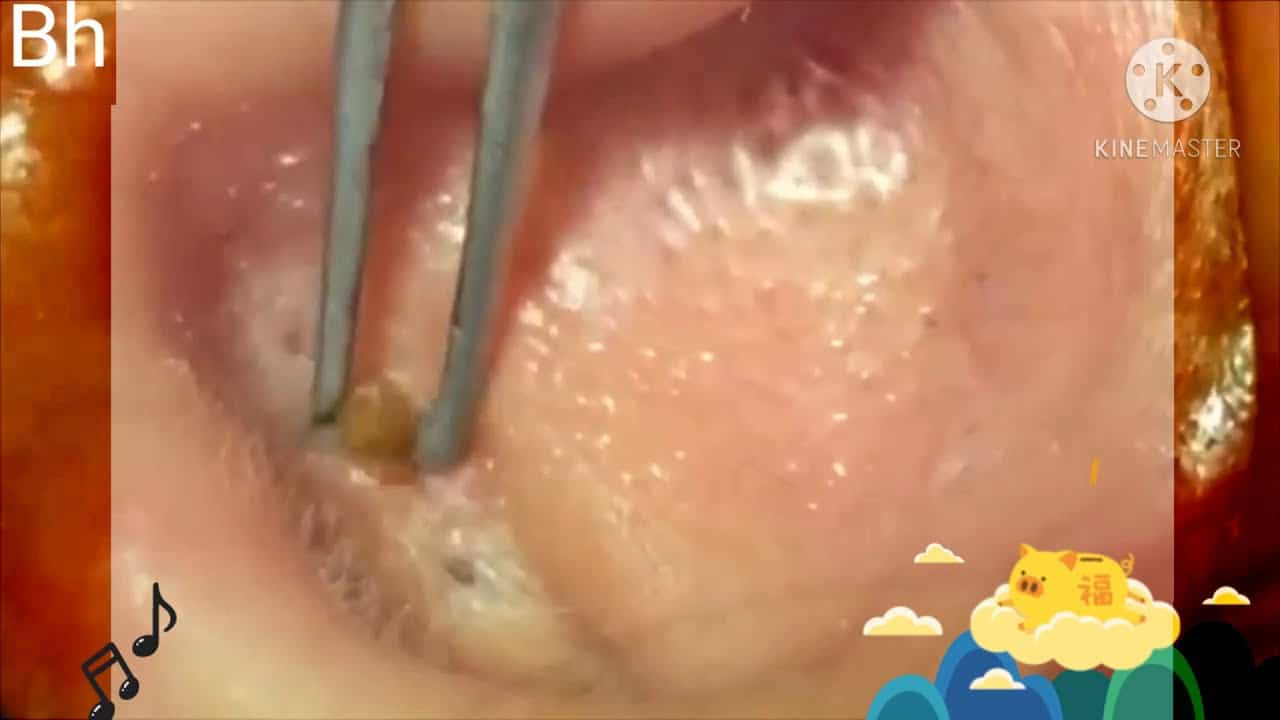 BIGGEST !! Blackhead Removal Videos 2019 Large Blackheads removal best pimple popping