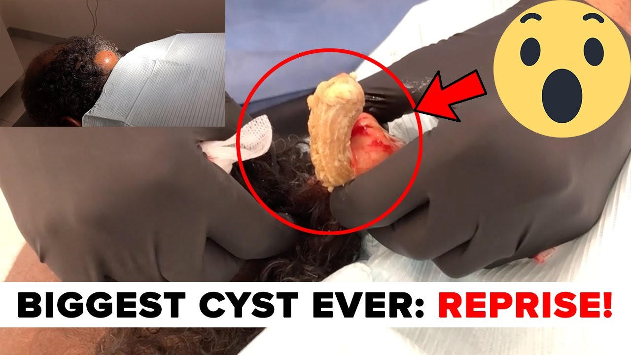 BIGGEST CYST EVER: REPRISE!