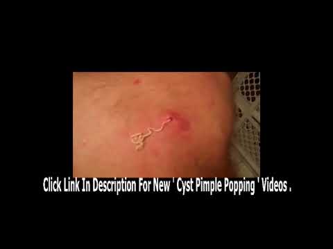 Biggest cyst pop ever !!   YouTube