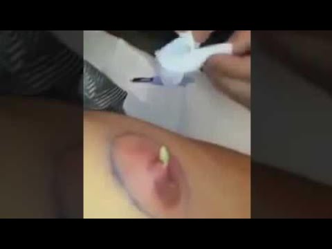 Biggest Cyst Pus Infection Pimple Popping Staph Infection Nasty   YouTube