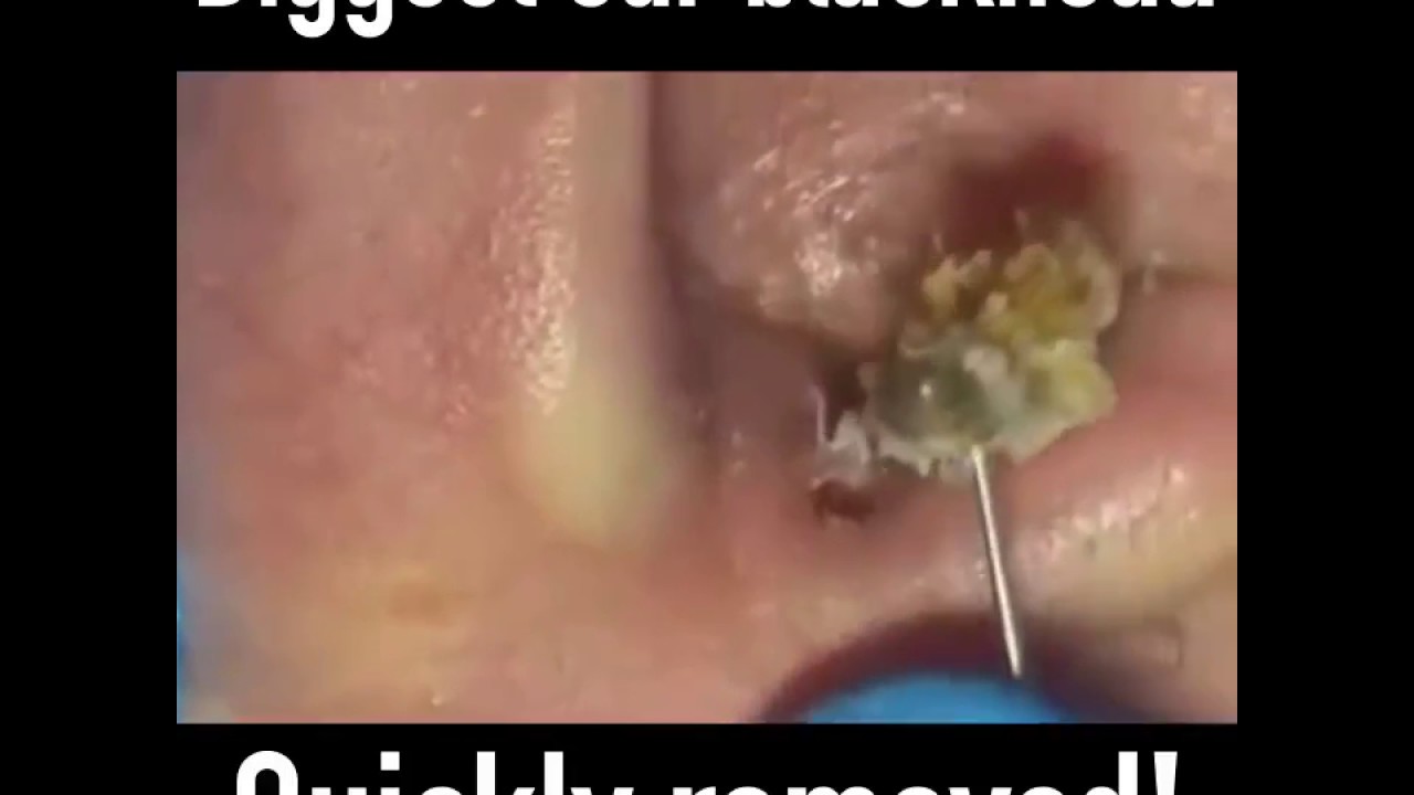 Biggest ear blackhead. Popping pimple 2017 Youtube Video