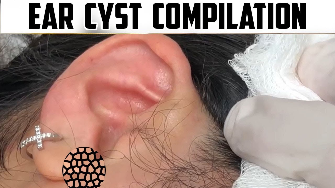 Biggest Ear Cysts of All Time with Dr. Gilmore!