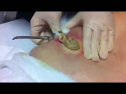 Biggest Pimple Pop Ever Seen 2016  Caught On Camera  Guiness World Record’s Biggest Pimple Ever !