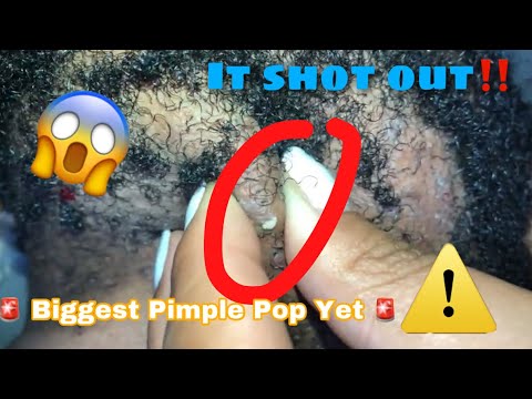 ? Biggest Pimple Pop Yet ?| Ingrown & Extraction 3| Neck & Beard Area