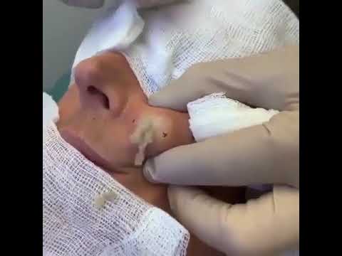 BIGGEST PIMPLE POP YOU WILL EVER SEE ???