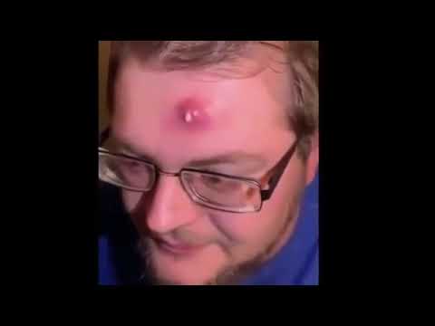 Biggest Pimple Popping || Blackheads Removing – SATISFYING (Compilation 2019 ) PART 2