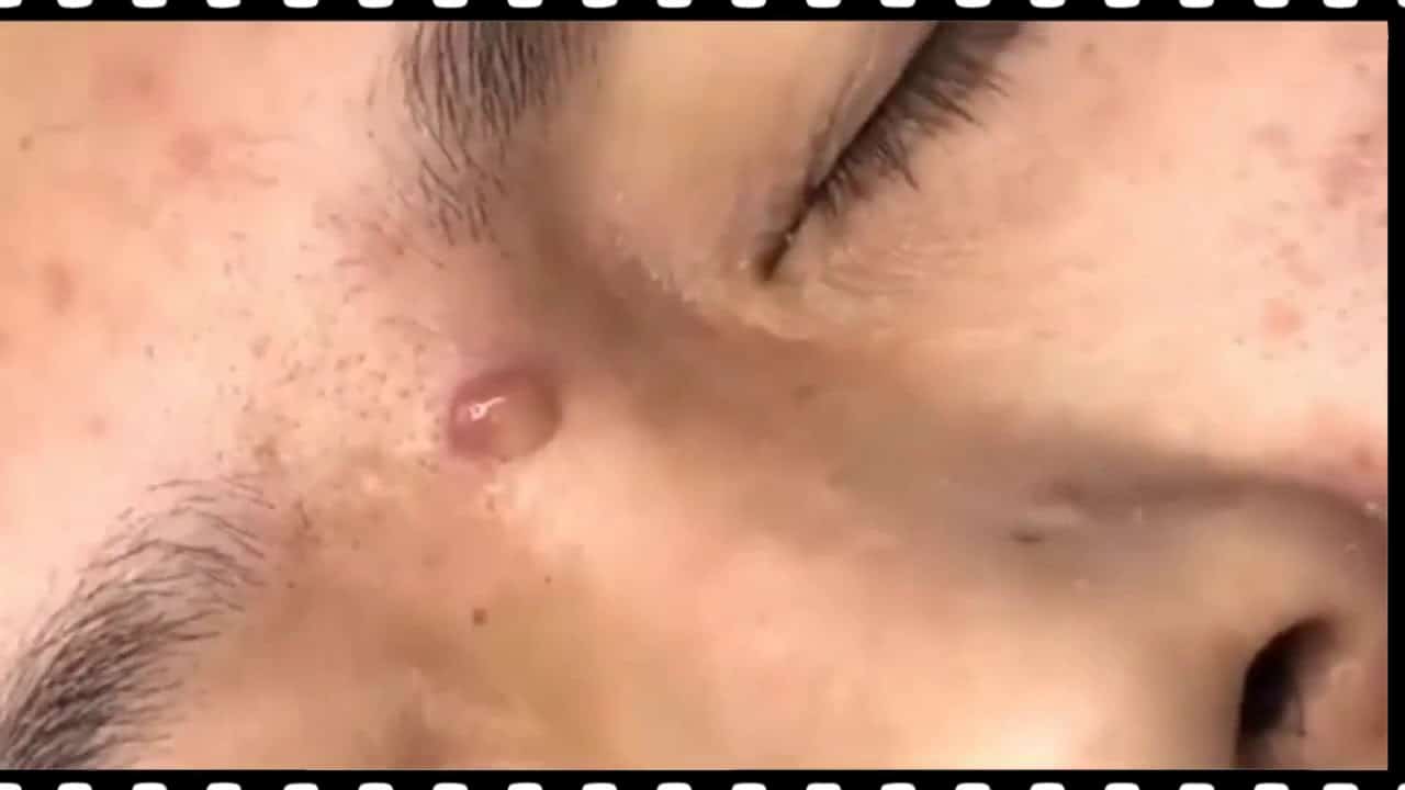 BIGGEST PIMPLE POPPING EXPLOSION BLACKHEAD REMOVAL 2020!!!