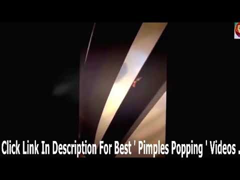 Biggest Zit Cyst Pop Ever ღ Best back cyst pimple popping ღ Most Amazing Pops 乂 part 6