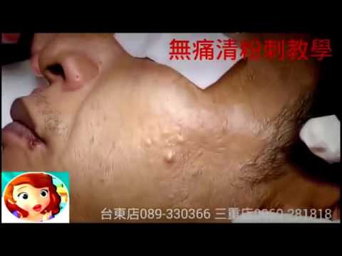 Biggest Zit Cyst Pop Ever ღ Best back cyst pimple popping ღ Most Amazing Pops 乂 part 8