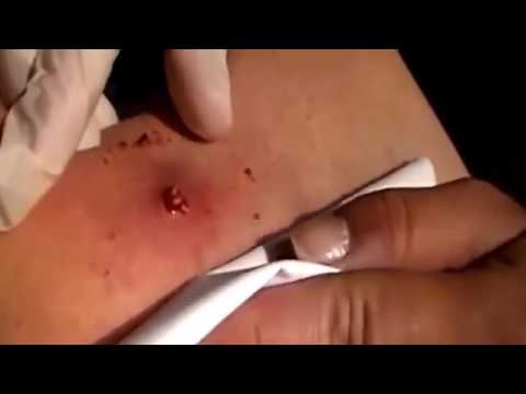 Biggest Zit Cyst Pop Ever ღ Best back cyst pimple popping ღ Most Amazing Pops 乂 part 5