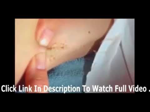 Biggest Zit Cyst Pop Ever {Gross Pimple Popping}   YouTube