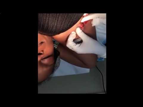Biggest Zit Cyst Pop Ever!! Most Amazing Pops Best back cyst pimple popping # 7