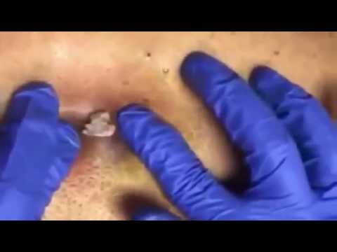 Biggest Zit Cyst Pop Ever! Most Amazing Pops Best back cyst pimple popping part 22