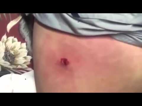 Biggest Zit Cyst Pop Ever!! Most Amazing Pops Best back cyst pimple popping #2