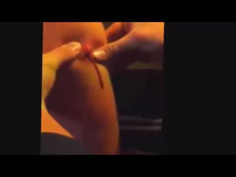 Biggest Zit Cyst Pop Ever!! Most Amazing Pops Best back cyst pimple popping #6