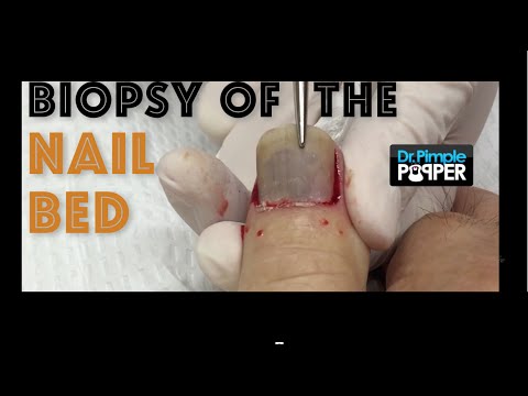 Biopsy of the nail bed with removal of the nail plate: Nail Avulsion