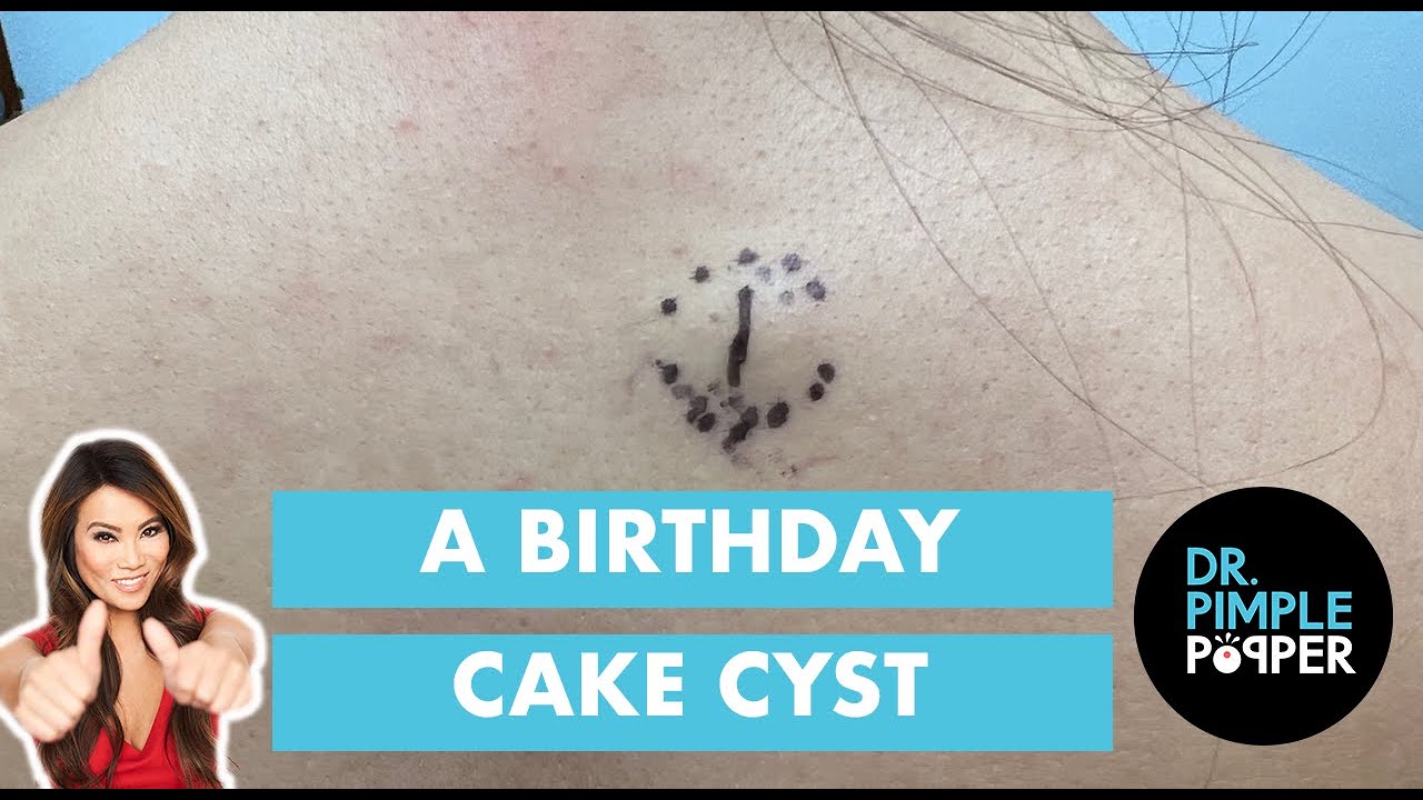 Birthday Cake Cyst With A Surprise You Can’t Miss!