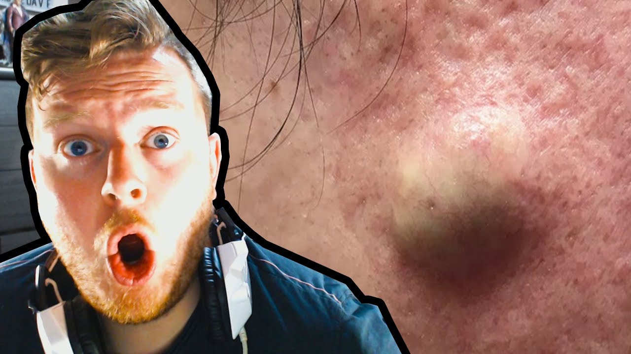 BitMoreDave Watches Pimple Popping