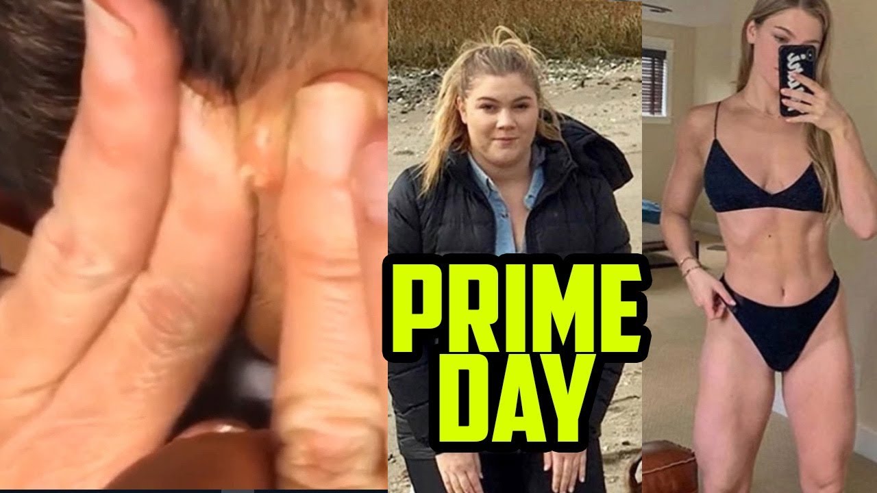Bizarre Pimples, Lipomas, Big Cysts & Greatest Weight Loss!