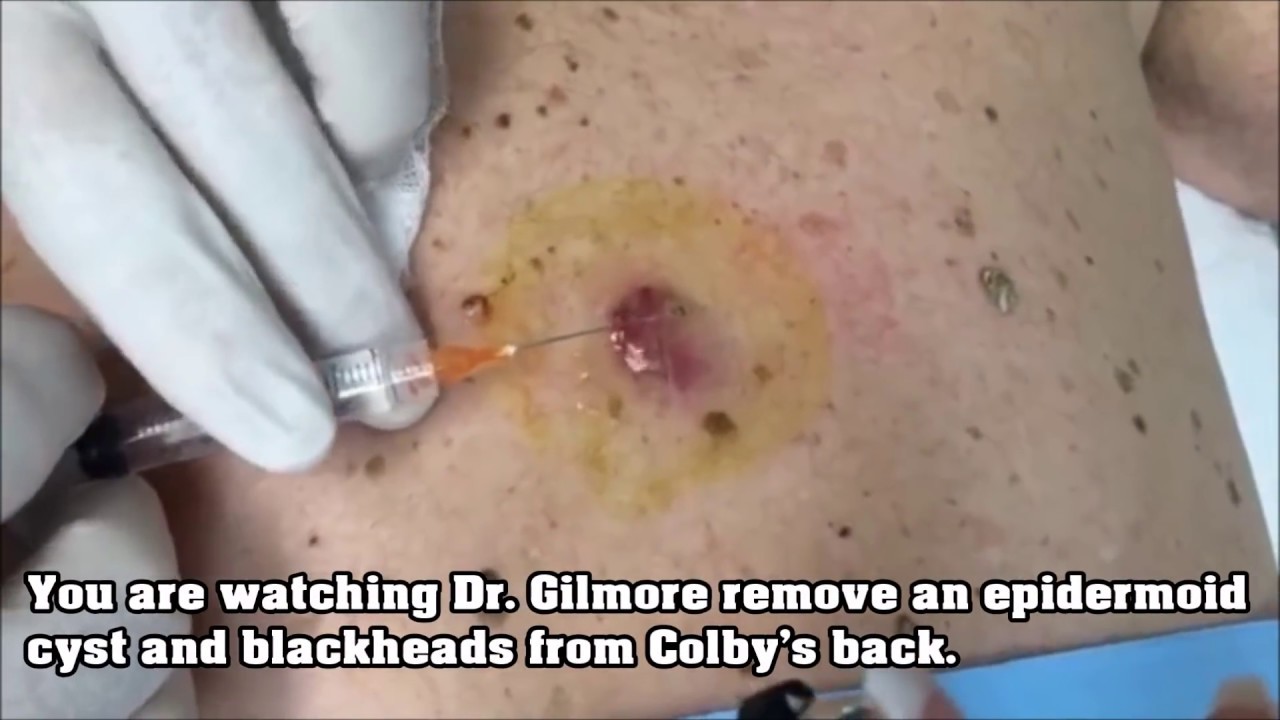 Black Blackheads, Cysts and Popping
