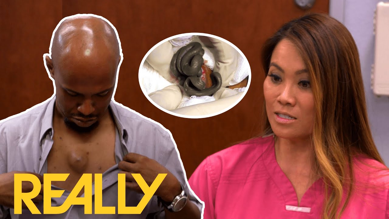 Black Gunk Oozes From Lump In Patient's Chest I Dr Pimple Popper: This Is Zit