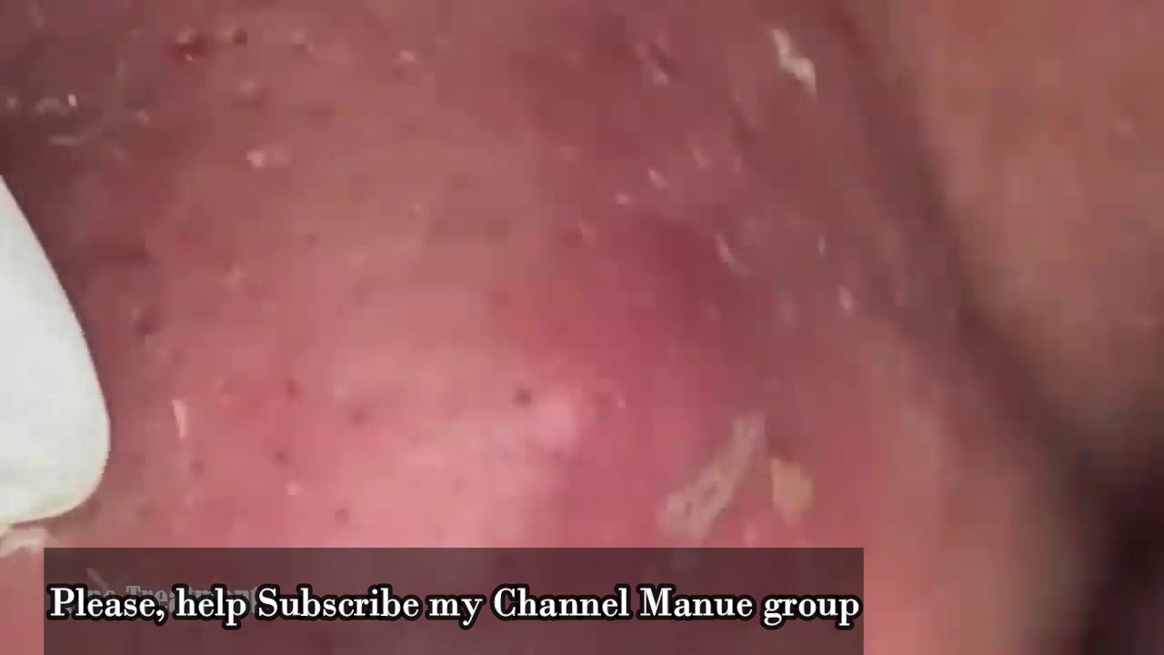 BLACKHEAD 04 Deep Blackheads Removal from Cheeks and Nose – Best Pimple Popping Videos