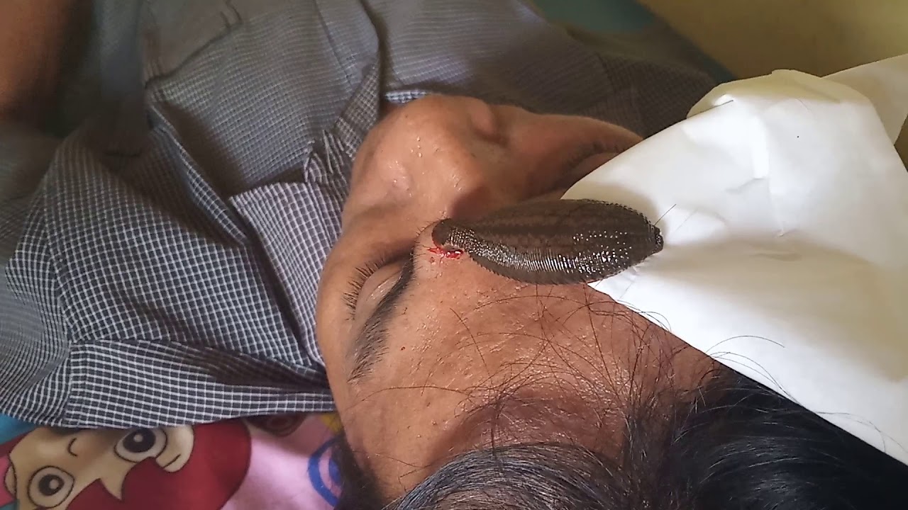 BLACKHEAD, ABSCEES, PIMPLE POPPING CYST EXTRACTION – LEECH THERAPY