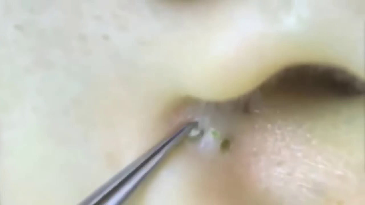Blackhead and Cyst Popping Completions 2019 ( Extractions)