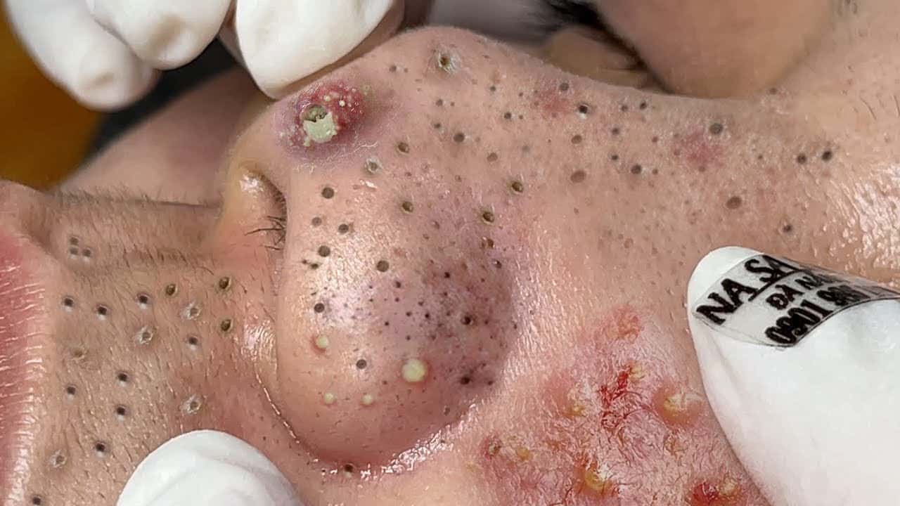✪ Blackhead Extraction | Acne Treatment  | Pimples Popping On man's face 2021