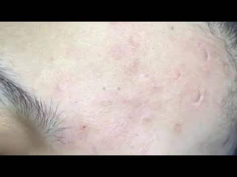 blackhead extraction, acne treatment, acne extraction Cystic acne, pimple popping, Part7