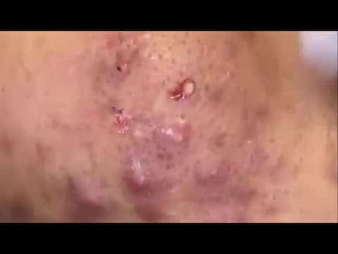 blackhead extraction, acne treatment, cystic acne, Satisfying pimple popping, Part6
