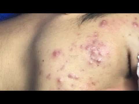 blackhead extraction, acne treatment, acne extraction Cystic acne, pimple popping, Part2