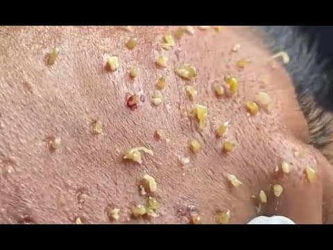 blackhead extraction, acne treatment, acne extraction Cystic acne, pimple popping, Part8